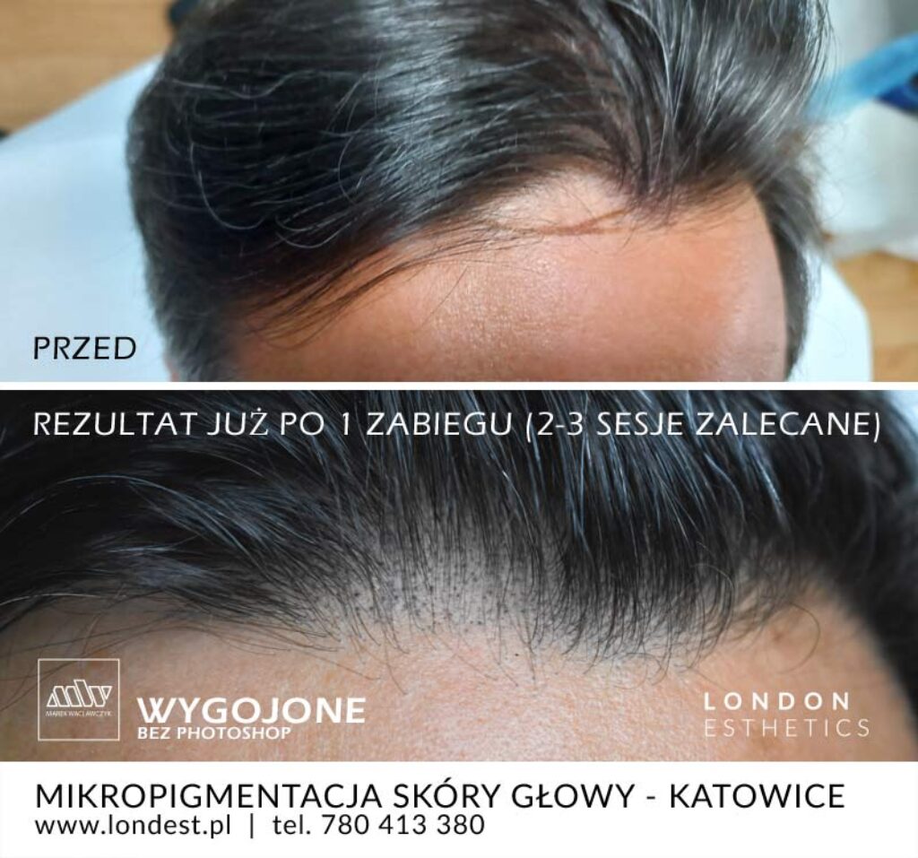 mikropigmentacja skóry głowy