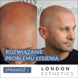 Mikropigmentacja skóry głowy: Innowacyjne Rozwiązanie dla Problemu Łysienia