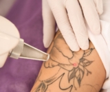 Jak wygląda laserowe usuwanie tatuażu?